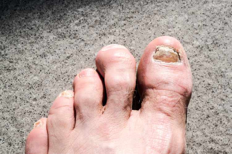 Causes and Treatments Options for Hammertoes